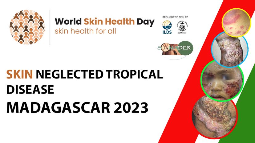 World Skin Health Day (Madagascar, Tunisia): Skin Neglected Tropical Diseases