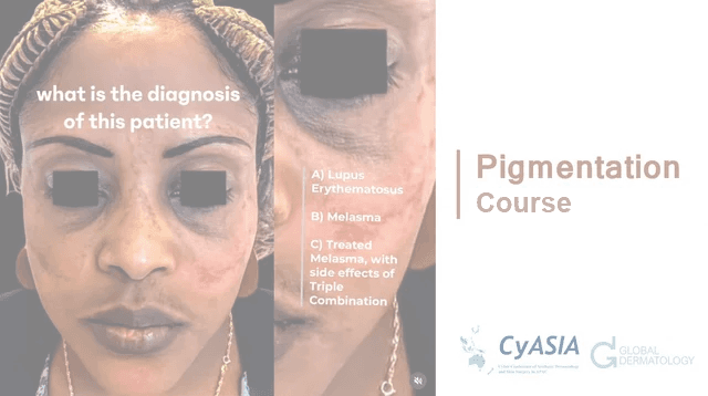 Pigmentation