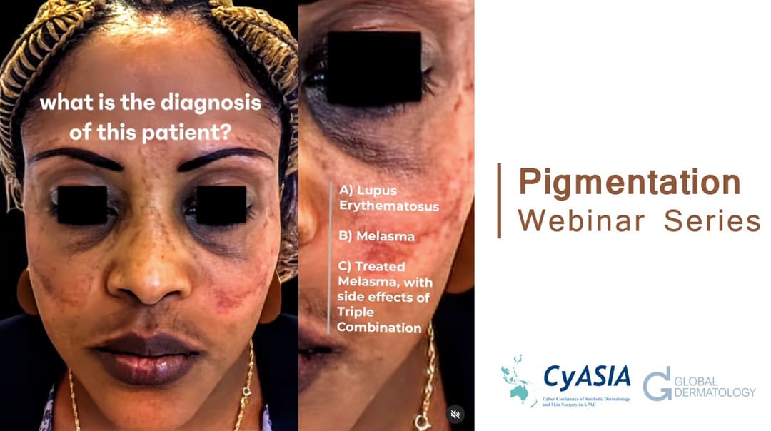 Pigmentation | Webinar Series -- Laser Toning & Hyperpigmentation Solutions